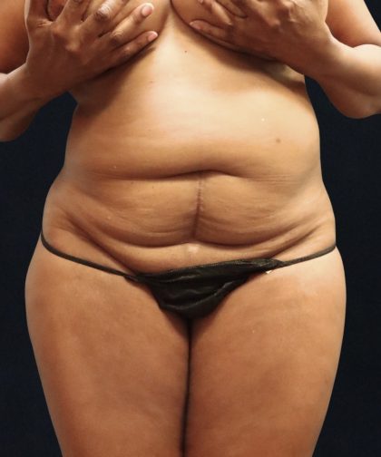 Tummy Tuck Before & After Patient #11532