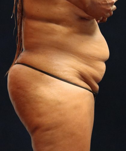 Tummy Tuck Before & After Patient #11532