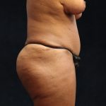 Tummy Tuck Before & After Patient #11532