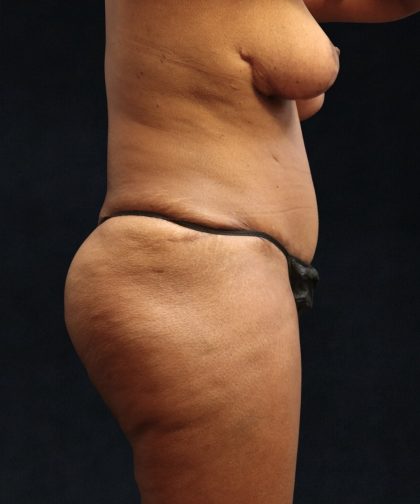 Tummy Tuck Before & After Patient #11532