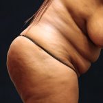 Tummy Tuck Before & After Patient #11532
