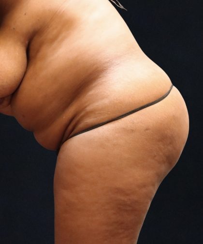 Tummy Tuck Before & After Patient #11532