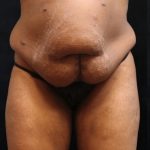 Tummy Tuck Before & After Patient #11533