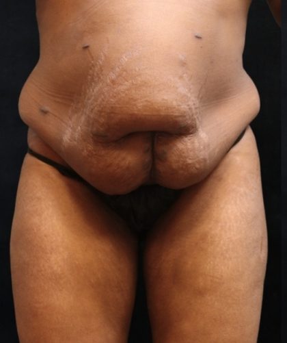 Tummy Tuck Before & After Patient #11533