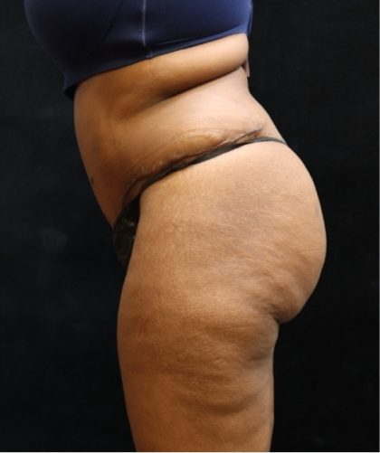 Tummy Tuck Before & After Patient #11533