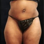 Tummy Tuck Before & After Patient #11533