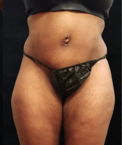 Tummy Tuck Before & After Patient #11533