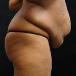 Tummy Tuck Before & After Patient #11533