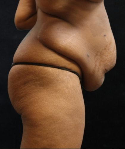 Tummy Tuck Before & After Patient #11533