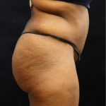 Tummy Tuck Before & After Patient #11533