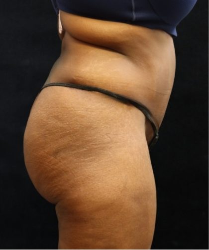 Tummy Tuck Before & After Patient #11533
