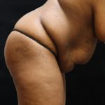 Tummy Tuck Before & After Patient #11533