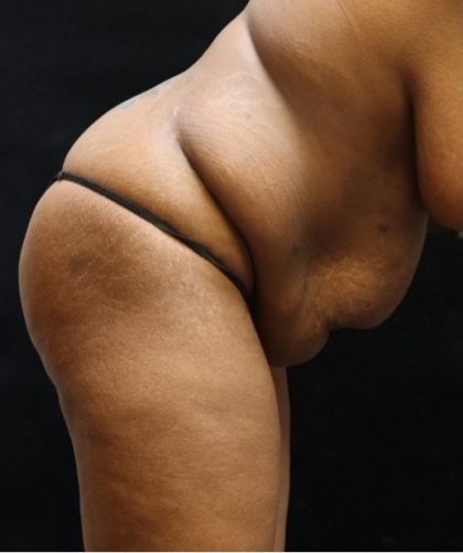 Tummy Tuck Before & After Patient #11533
