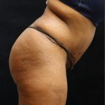 Tummy Tuck Before & After Patient #11533