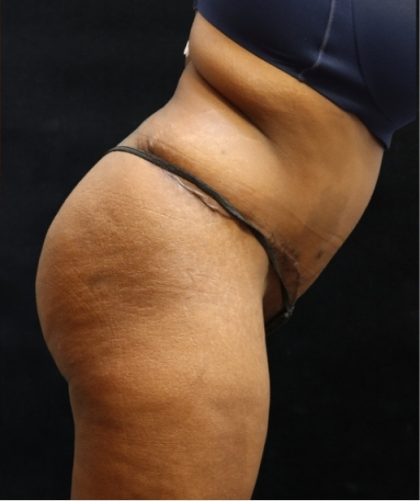 Tummy Tuck Before & After Patient #11533