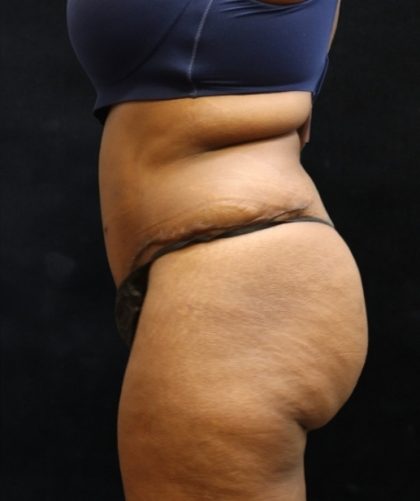 Tummy Tuck Before & After Patient #11533