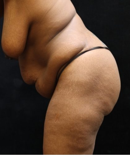 Tummy Tuck Before & After Patient #11533