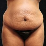 Tummy Tuck Before & After Patient #11534