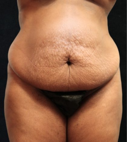 Tummy Tuck Before & After Patient #11534