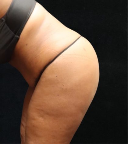 Tummy Tuck Before & After Patient #11534