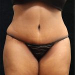 Tummy Tuck Before & After Patient #11534