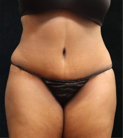 Tummy Tuck Before & After Patient #11534