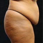 Tummy Tuck Before & After Patient #11534