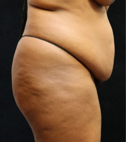 Tummy Tuck Before & After Patient #11534