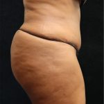Tummy Tuck Before & After Patient #11534