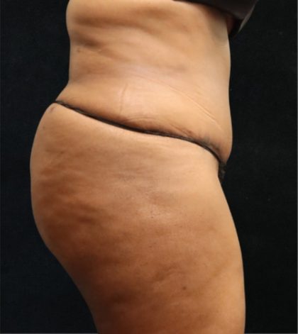 Tummy Tuck Before & After Patient #11534