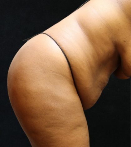 Tummy Tuck Before & After Patient #11534
