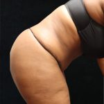 Tummy Tuck Before & After Patient #11534