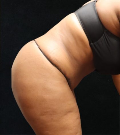 Tummy Tuck Before & After Patient #11534