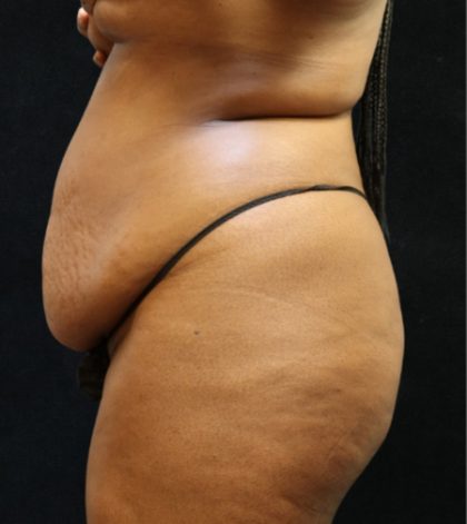 Tummy Tuck Before & After Patient #11534