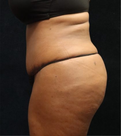 Tummy Tuck Before & After Patient #11534