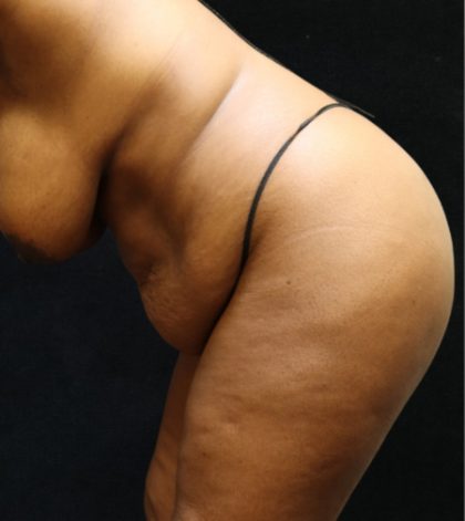 Tummy Tuck Before & After Patient #11534