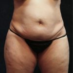 Tummy Tuck Before & After Patient #11535
