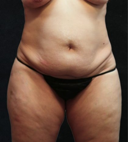 Tummy Tuck Before & After Patient #11535