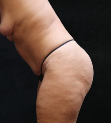 Tummy Tuck Before & After Patient #11535