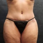 Tummy Tuck Before & After Patient #11535