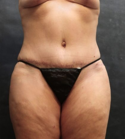 Tummy Tuck Before & After Patient #11535