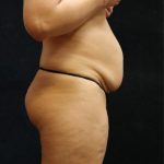 Tummy Tuck Before & After Patient #11535