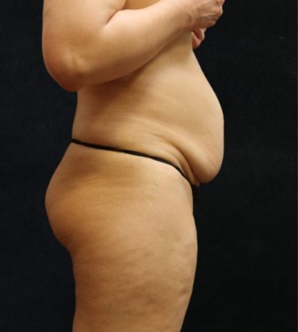 Tummy Tuck Before & After Patient #11535