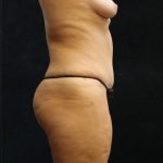 Tummy Tuck Before & After Patient #11535