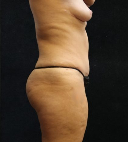 Tummy Tuck Before & After Patient #11535