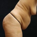 Tummy Tuck Before & After Patient #11535