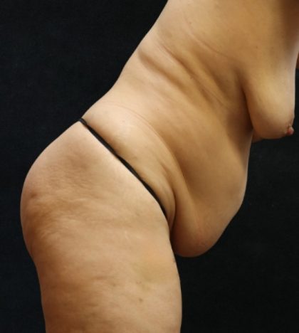 Tummy Tuck Before & After Patient #11535