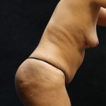 Tummy Tuck Before & After Patient #11535