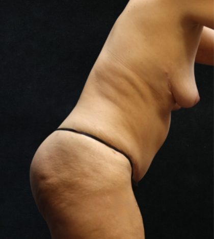 Tummy Tuck Before & After Patient #11535