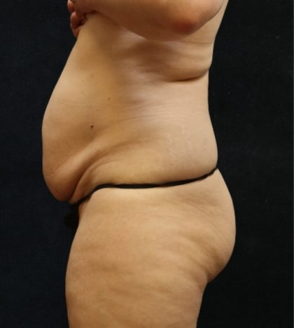 Tummy Tuck Before & After Patient #11535